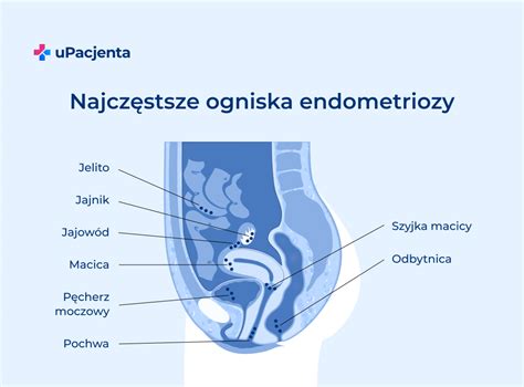 czy przy endometriozie może się spóźniać okres|Leczenie endometriozy: 70 pytań i odpowiedzi, które lepiej znać